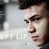 Cleft Lip