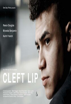 Cartel de Cleft Lip